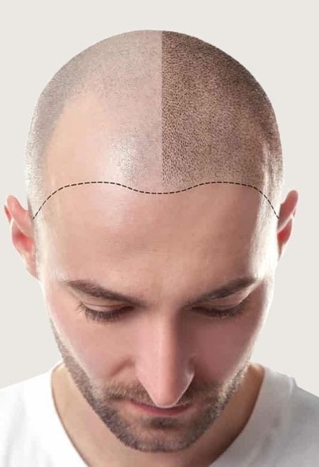 hair transplant procedure